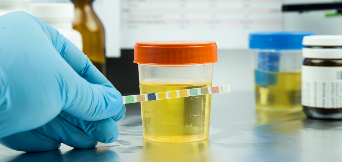 ¿como se llama el examen de orina para detectar drogas?
