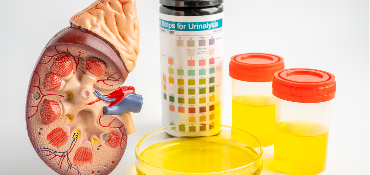 Examen de uroanálisis, tiras disponibles en Cali